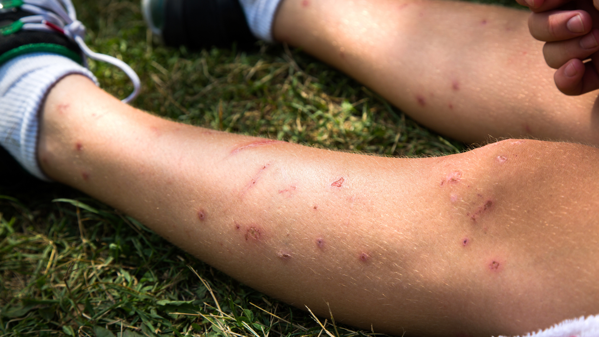 mosquito bites on leg